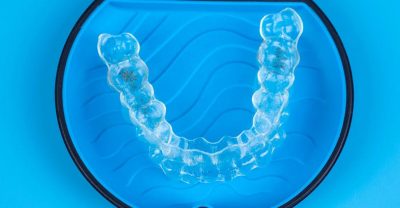 Invisalign in Newcastle Important Questions to Ask (1)